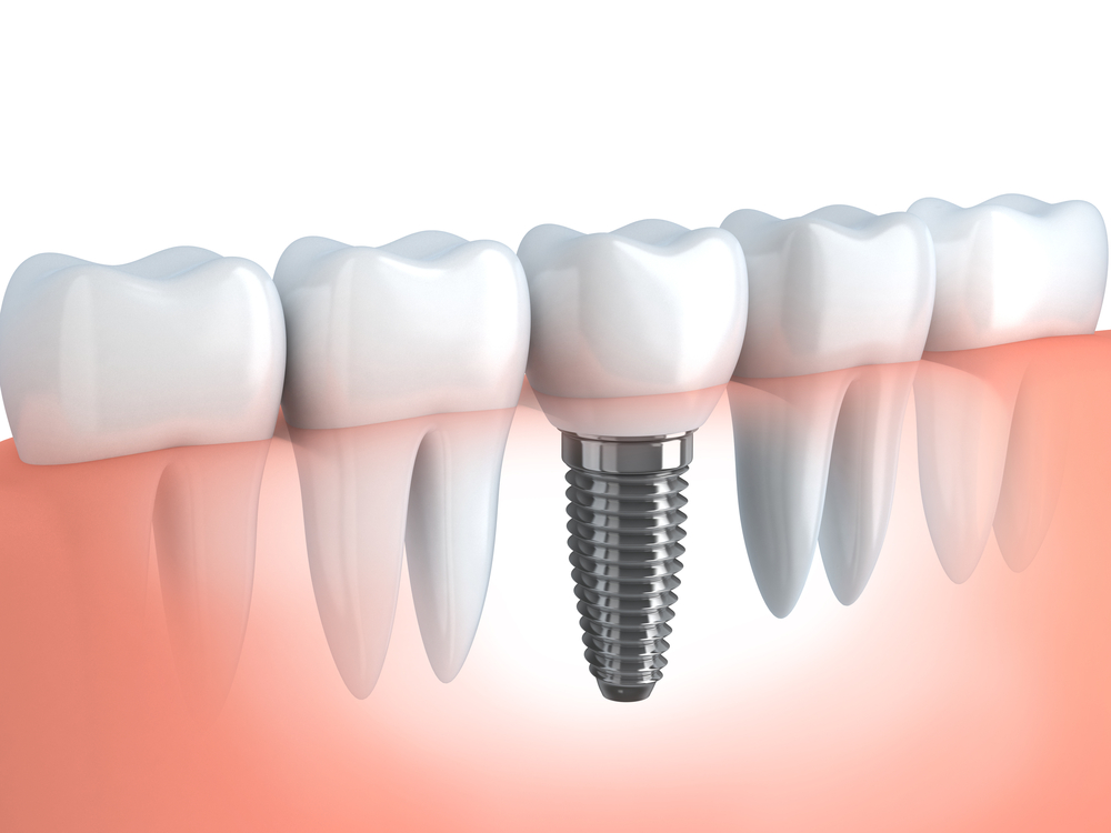 Prótese dentária e implante dentário: Qual a diferença?